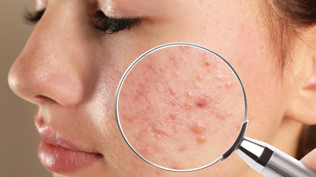 How To Tell If Acne Is Hormonal Or Bacterial Synstreamenergy